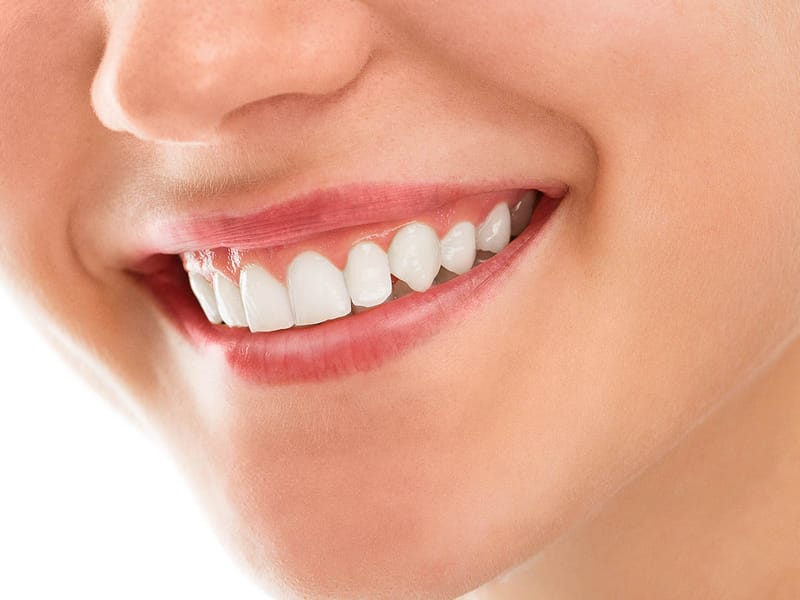 Buzëqeshje natyrale pas trajtimit estetik dentar